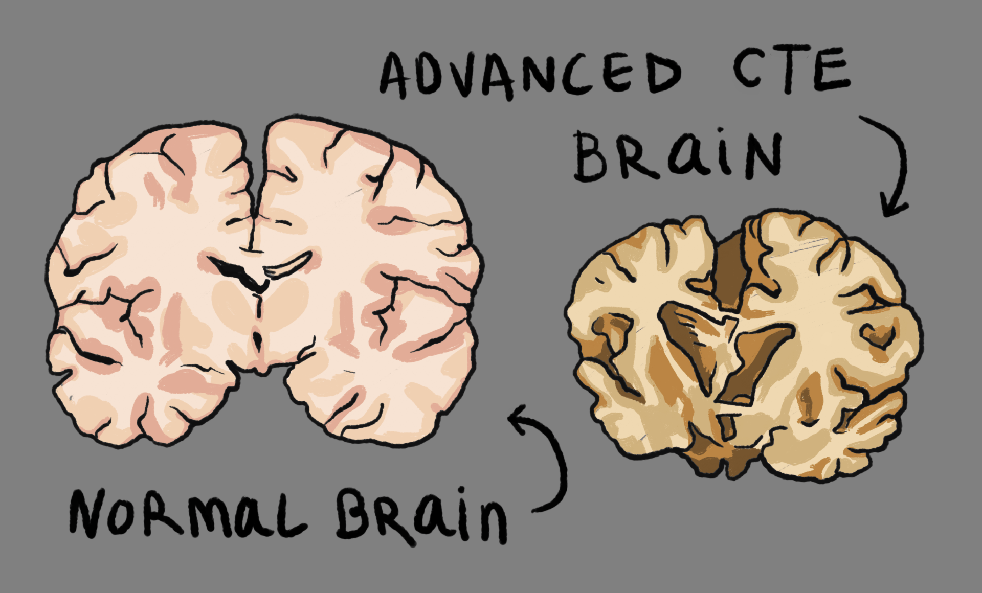 We need brain donations to further CTE / TES research!